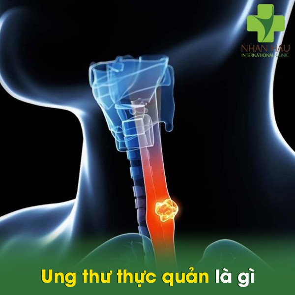 Ung thư thực quản nên điều trị như thế nào 2 Ung thư thực quản là gì