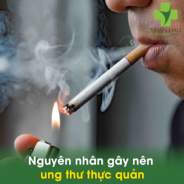 Ung thư thực quản nên điều trị như thế nào 3 Nguyên nhân gây nên ung thư thực quản
