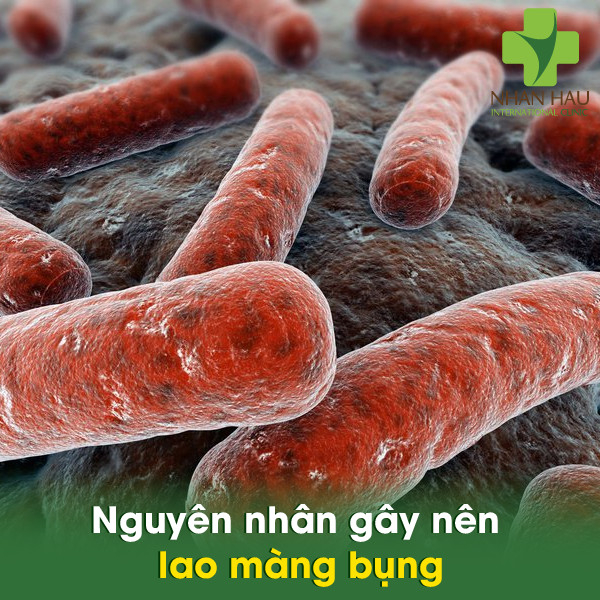 Lao màng bụng nguy hiểm như thế nào 3 Nguyên nhân gây nên lao màng bụng