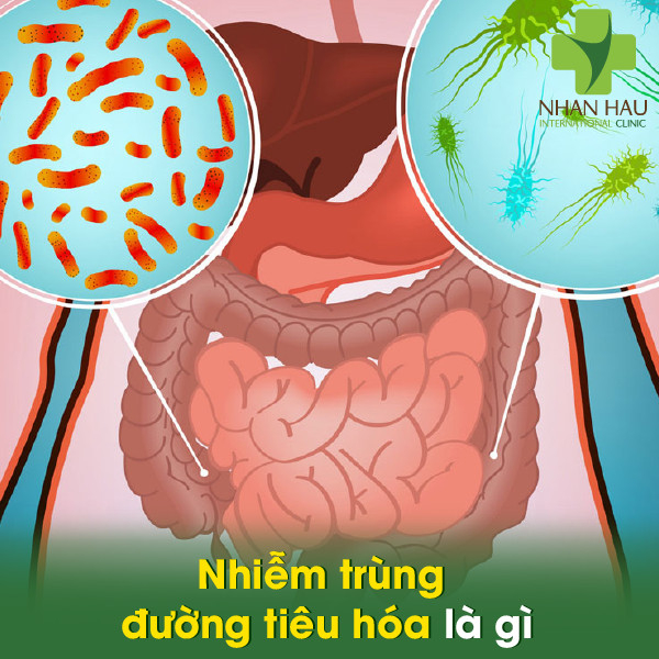 Nhiễm trùng đường tiêu hóa và biến chứng nên lưu ý 2 Nhiễm trùng đường tiêu hóa là gì