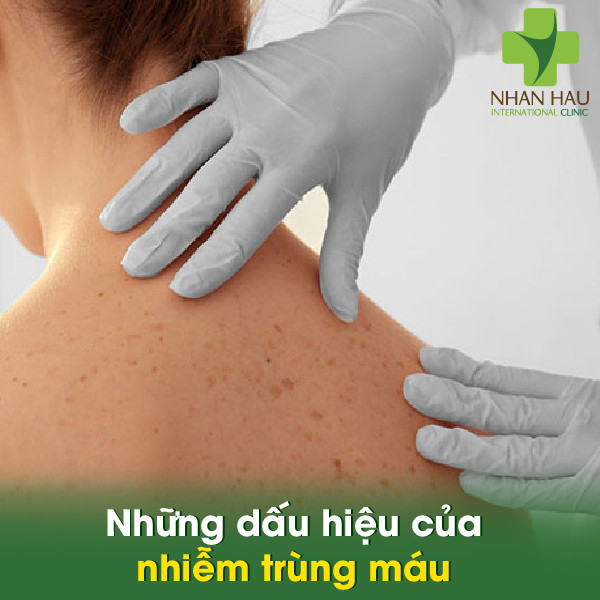 Nhiễm trùng máu nếu không điều trị sẽ gây ra vấn đề gì? 4 Những dấu hiệu của nhiễm trùng máu