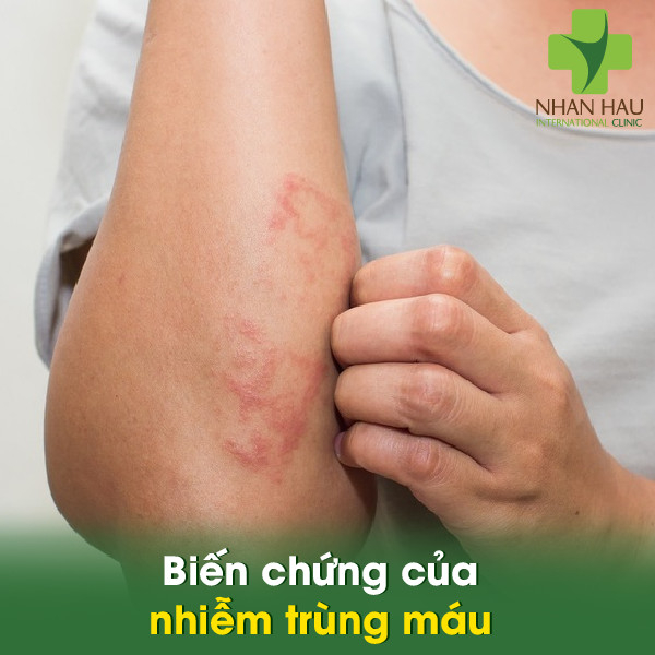 Nhiễm trùng máu nếu không điều trị sẽ gây ra vấn đề gì? 5 Biến chứng của nhiễm trùng máu