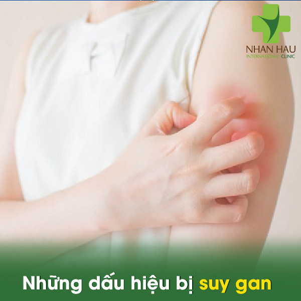 Suy gan và những dấu hiệu của suy gan 4 Những dấu hiệu bị suy gan