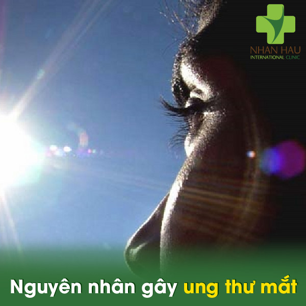 Ung thư mắt nên phòng ngừa như thế nào 2 Nguyên nhân gây ung thư mắt