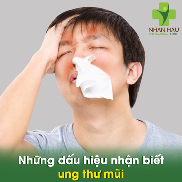 Những lưu ý cần thiết cho ung thư mũi 4 Những dấu hiệu nhận biết ung thư mũi