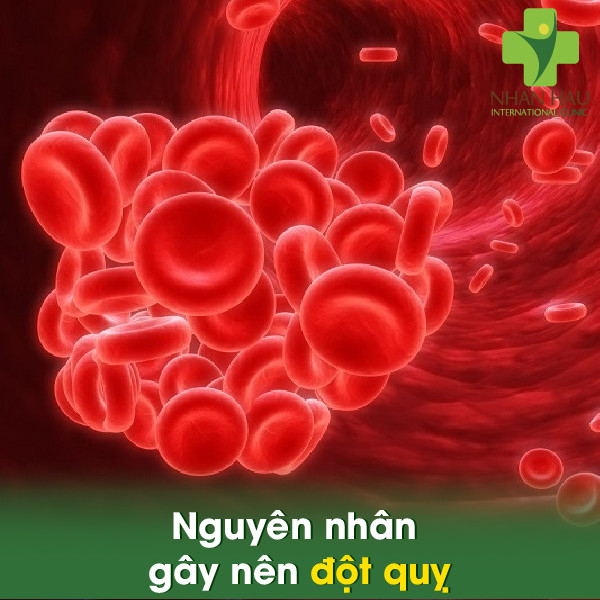 Đột quỵ sẽ có những nguy hiểm gì 2 Nguyên nhân gây nên đột quỵ
