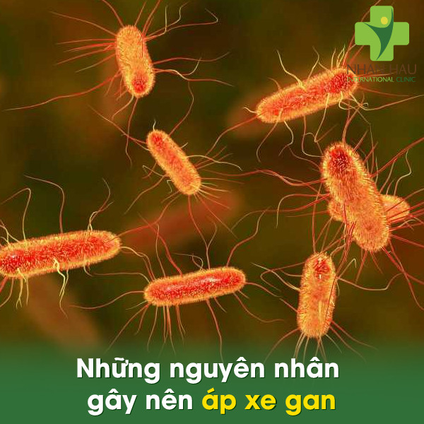 Bệnh áp xe gan sẽ gây nên những nguy hiểm gì cho cơ thể 3 Những nguyên nhân gây nên áp xe gan