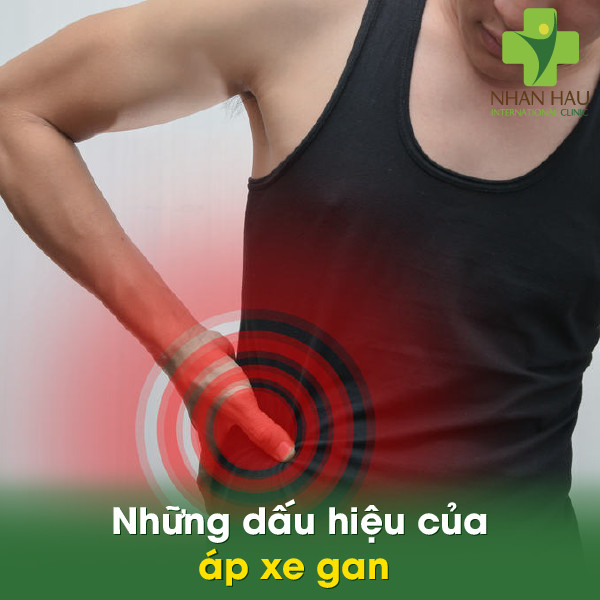 Bệnh áp xe gan sẽ gây nên những nguy hiểm gì cho cơ thể 4 Những dấu hiệu của áp xe gan