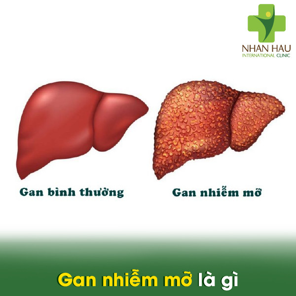 Gan nhiễm mỡ nếu không được điều trị kịp thời thì có nguy hiểm không 2 Gan nhiễm mỡ là gì