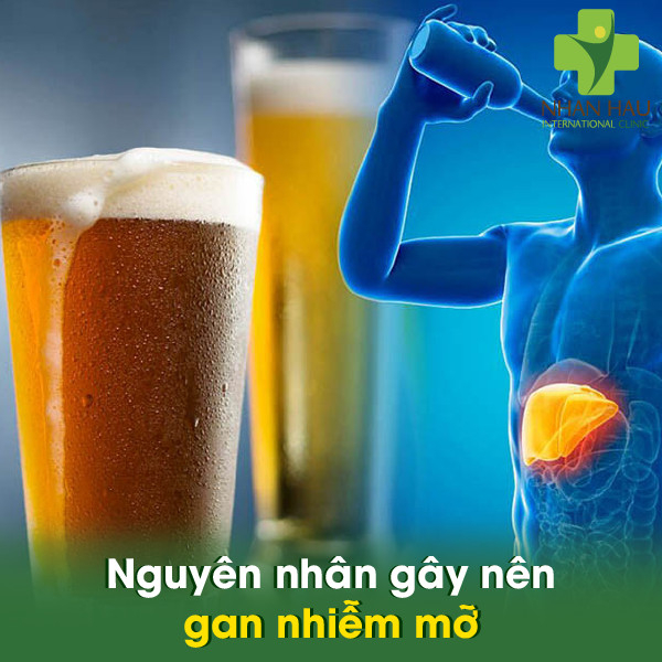 Gan nhiễm mỡ nếu không được điều trị kịp thời thì có nguy hiểm không 3 Nguyên nhân gây nên gan nhiễm mỡ
