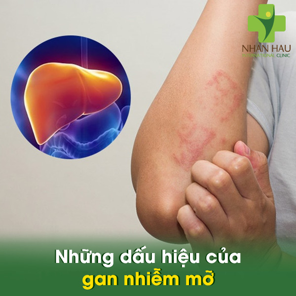 Gan nhiễm mỡ nếu không được điều trị kịp thời thì có nguy hiểm không 4 Những dấu hiệu của gan nhiễm mỡ