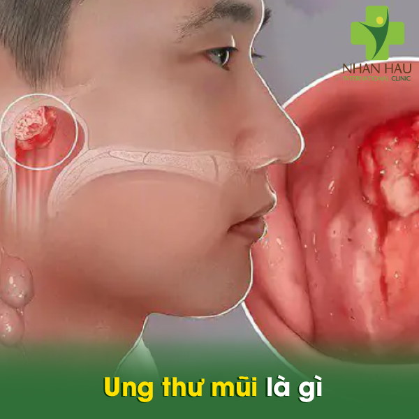 Những lưu ý cần thiết cho ung thư mũi 2 Ung thư mũi là gì