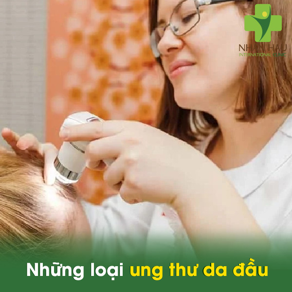 Ung thư da đầu và những triệu chứng 2 Các loại ung thư da đầu