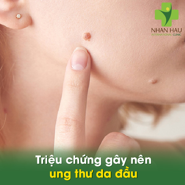 Ung thư da đầu và những triệu chứng 4 Triệu chứng gây nên ung thư da đầu
