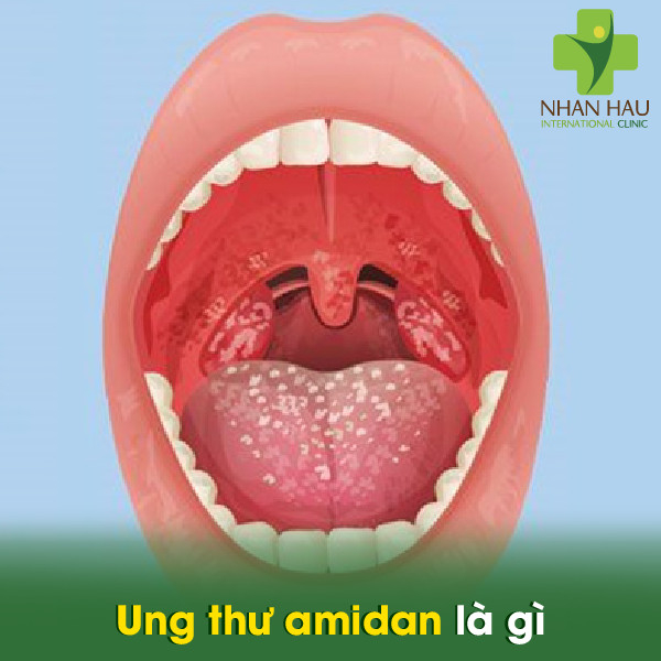 Ung thư Amidan có nguy hiểm không 2 Ung thư amidan là gì