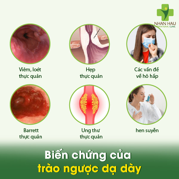 Mẹo Chữa Trào Ngược Dạ Dày Tại Nhà: Cách Giảm Triệu Chứng và Khắc Phục 3 Biến chứng của trào ngược dạ dày