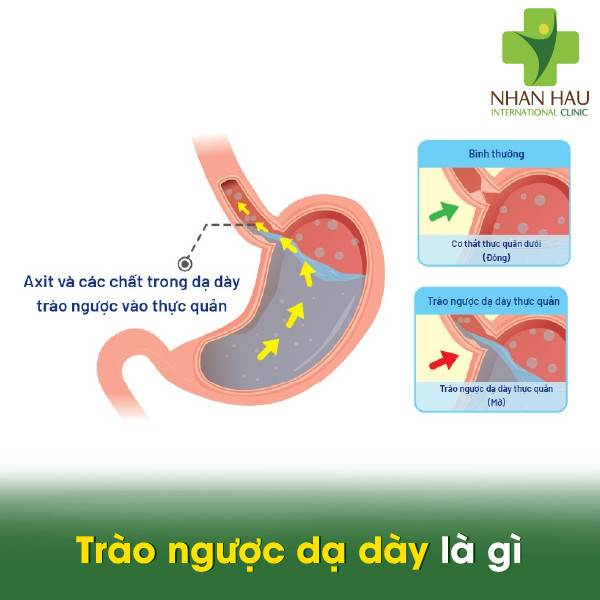 Trào ngược dạ dày là gì? triệu chứng, nguyên nhân và cách điều trị 1 Trào ngược dạ dày là gì