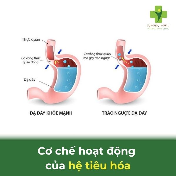 Trào ngược dạ dày là gì? triệu chứng, nguyên nhân và cách điều trị 2 hệ tiêu hóa người, chú thích rõ dạ dày, thực quản, van tâm vị và mũi tên chỉ chiều di chuyển thức ăn bình thường và chiều trào ngược khi bị GERD