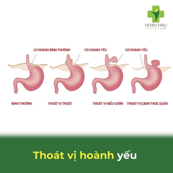 Trào ngược dạ dày là gì? triệu chứng, nguyên nhân và cách điều trị 6 so sánh dạ dày ở vị trí bình thường và dạ dày bị thoát vị lên trên cơ hoành, làm suy yếu van tâm vị