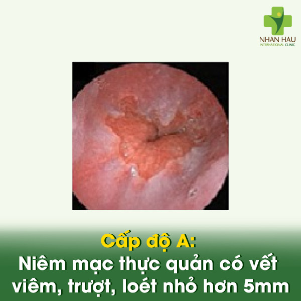 Cấp độ A: Niêm mạc thực quản có vết viêm, trượt, loét nhỏ hơn 5mm.