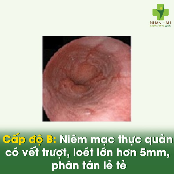 Cấp độ B: Niêm mạc thực quản có vết trượt, loét lớn hơn 5mm, phân tán lẻ tẻ.