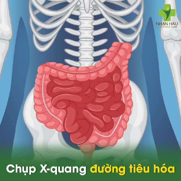So sánh các loại xét nghiệm trào ngược dạ dày hiện nay 2 Chụp X-quang đường tiêu hóa