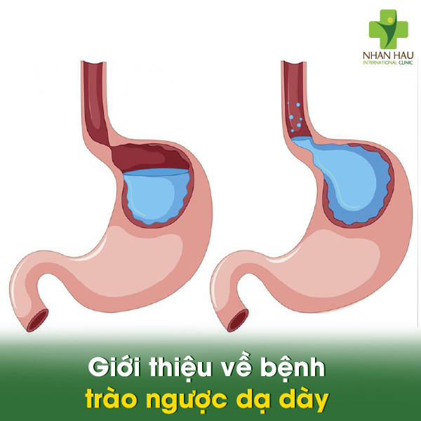 Giới thiệu về bệnh trào ngược dạ dày