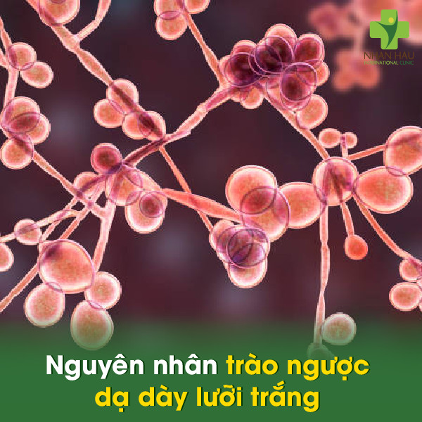 Trào ngược dạ dày lưỡi trắng: Nguyên nhân, triệu chứng và cách điều trị 2 Nguyên nhân trào ngược dạ dày lưỡi trắng