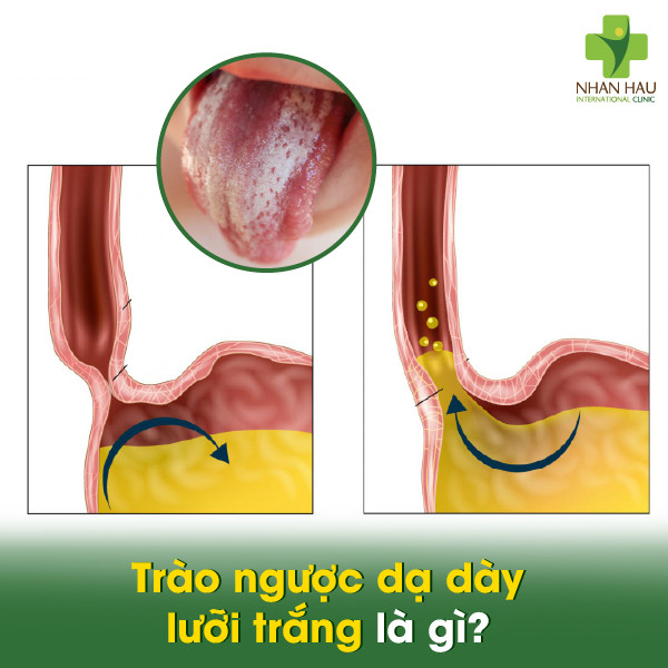 Trào ngược dạ dày lưỡi trắng: Nguyên nhân, triệu chứng và cách điều trị 1 Trào ngược dạ dày lưỡi trắng là gì?
