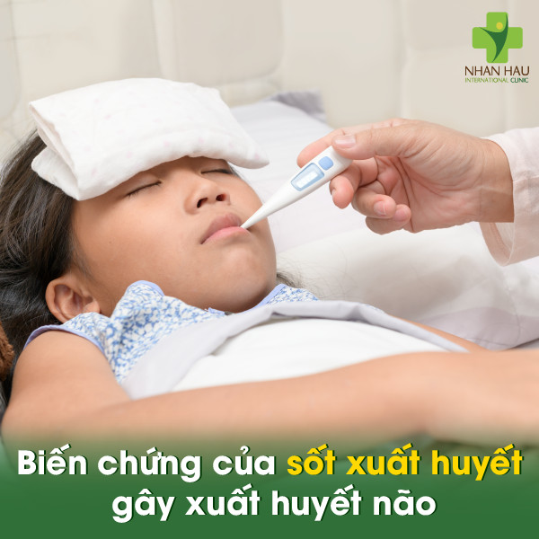 Biến chứng sốt xuất huyết: Hậu quả đáng lo ngại 5 Biến chứng của sốt xuất huyết gây xuất huyết não