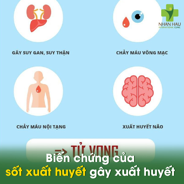Biến chứng sốt xuất huyết: Hậu quả đáng lo ngại 1 Biến chứng của sốt xuất huyết gây xuất huyết