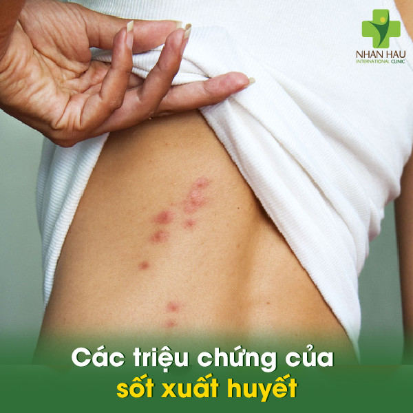 Kế hoạch chăm sóc bệnh nhân sốt xuất huyết và những điều cần lưu ý 1 Các triệu chứng của sốt xuất huyết