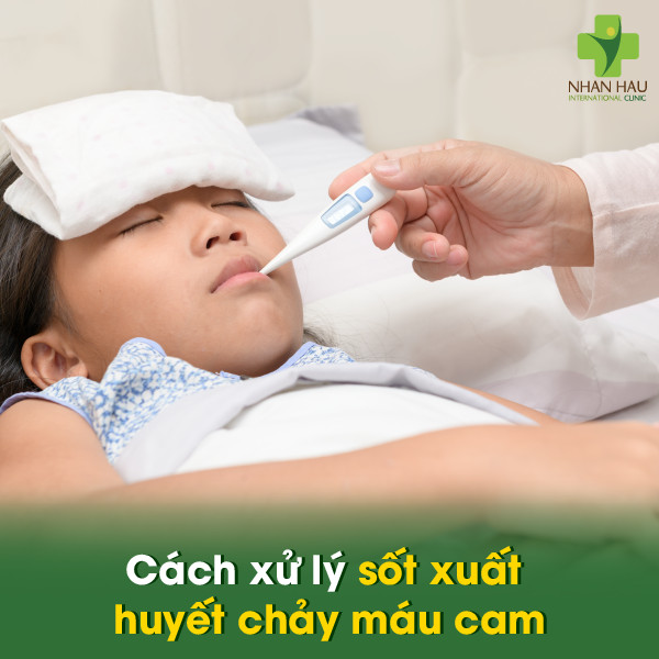 Sốt xuất huyết chảy máu cam: Nguyên nhân, triệu chứng, cách xử lý và phòng tránh 3 Cách xử lý sốt xuất huyết chảy máu cam