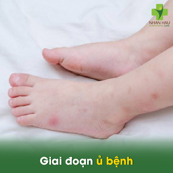 Các giai đoạn sốt xuất huyết: Diễn biến, triệu chứng và cách phòng ngừa 1 Giai đoạn ủ bệnh
