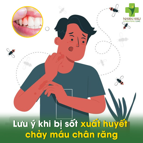 Sốt xuất huyết chảy máu chân răng: Nguyên nhân, triệu chứng, cách phòng ngừa và điều trị 5 Lưu ý khi bị sốt xuất huyết chảy máu chân răng