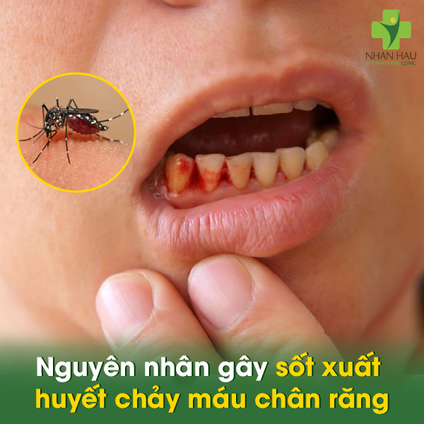 Sốt xuất huyết chảy máu chân răng: Nguyên nhân, triệu chứng, cách phòng ngừa và điều trị 1 Nguyên nhân gây sốt xuất huyết chảy máu chân răng