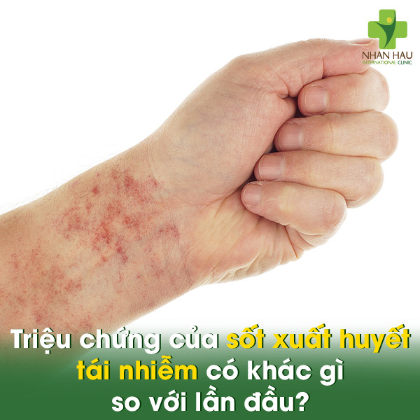 Sốt xuất huyết có bị lại không? Tái nhiễm có nguy hiểm không? 3 Triệu chứng của sốt xuất huyết tái nhiễm có khác gì so với lần đầu?