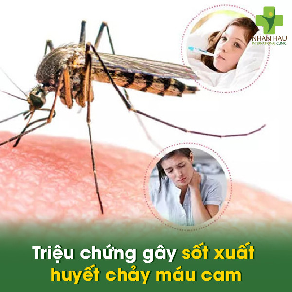 Sốt xuất huyết chảy máu cam: Nguyên nhân, triệu chứng, cách xử lý và phòng tránh 2 Triệu chứng gây sốt xuất huyết chảy máu cam