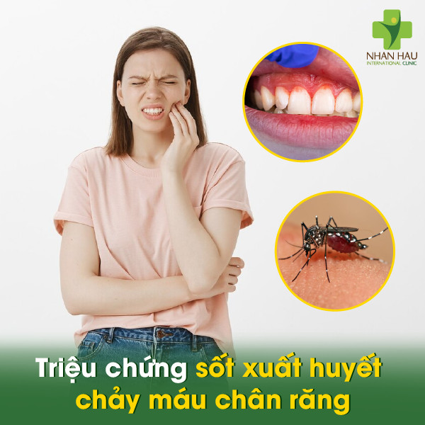 Sốt xuất huyết chảy máu chân răng: Nguyên nhân, triệu chứng, cách phòng ngừa và điều trị 2 Triệu chứng sốt xuất huyết chảy máu chân răng