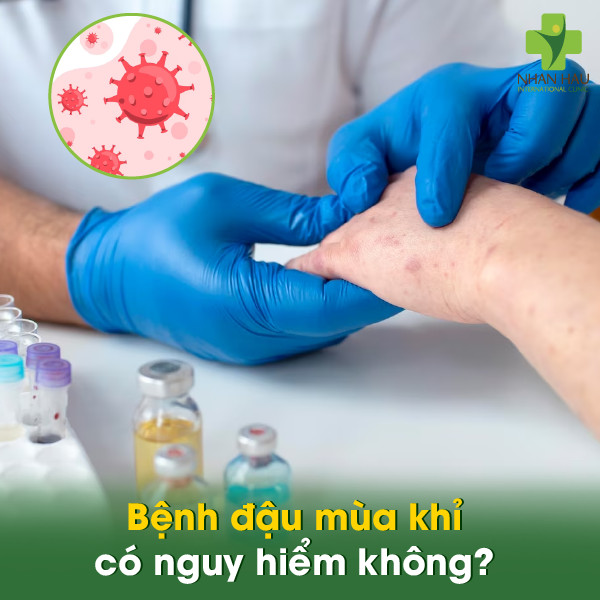 Bệnh đậu mùa khỉ: Nguyên nhân, triệu chứng, cách phòng tránh 5 Bệnh đậu mùa khỉ có nguy hiểm không