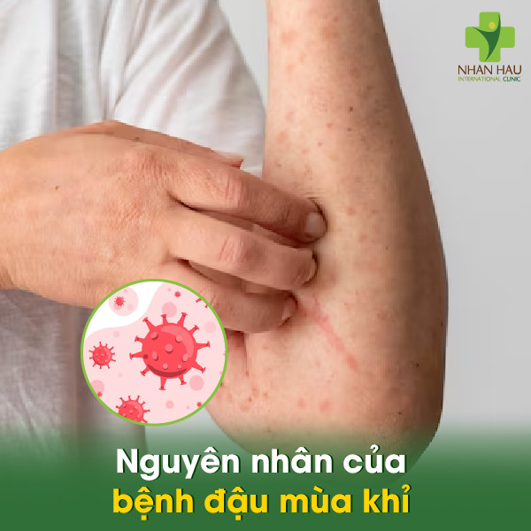 Bệnh đậu mùa khỉ: Nguyên nhân, triệu chứng, cách phòng tránh 2 Nguyên nhân của bệnh đậu mùa khỉ