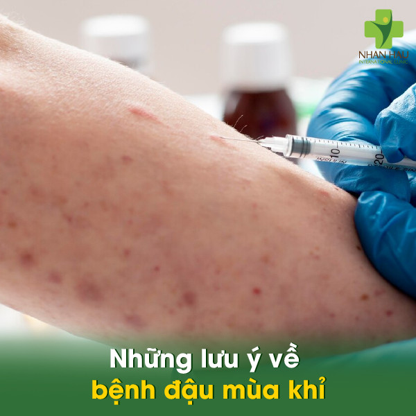 Bệnh đậu mùa khỉ: Nguyên nhân, triệu chứng, cách phòng tránh 7 Những lưu ý về bệnh đậu mùa khỉ