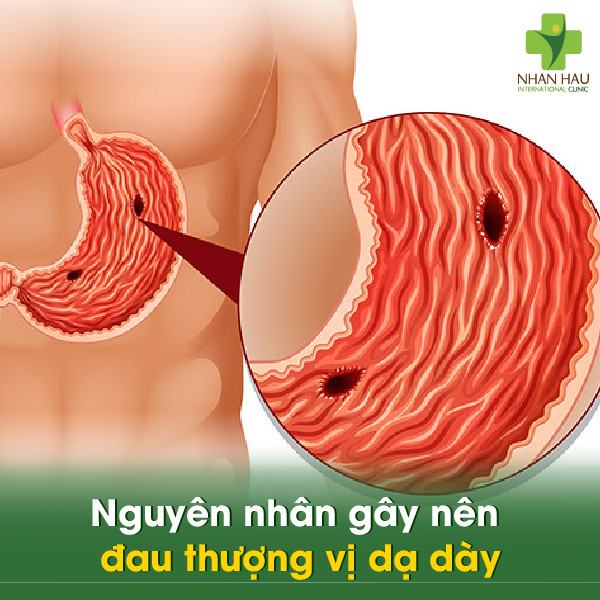Mẹo chữa đau thượng vị dạ dày tại nhà an toàn 1 Nguyên nhân gây nên đau thượng vị dạ dày