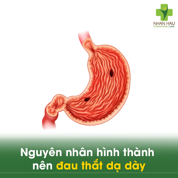 Đau thắt dạ dày: Nên làm thế nào giảm đau nhanh? 1 Nguyên nhân hình thành nên đau thắt dạ dày