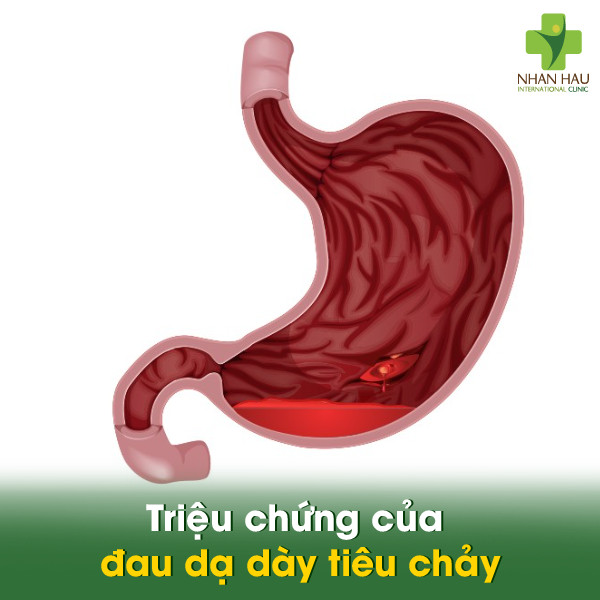 Đau dạ dày tiêu chảy: Cách điều trị và lời khuyên của bác sĩ 2 Triệu chứng của đau dạ dày tiêu chảy