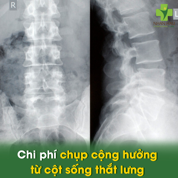Chụp cộng hưởng từ cột sống thắt lưng: Giải đáp về chi phí, quy trình và ứng dụng 3 Chi phí chụp cộng hưởng từ cột sống thắt lưng