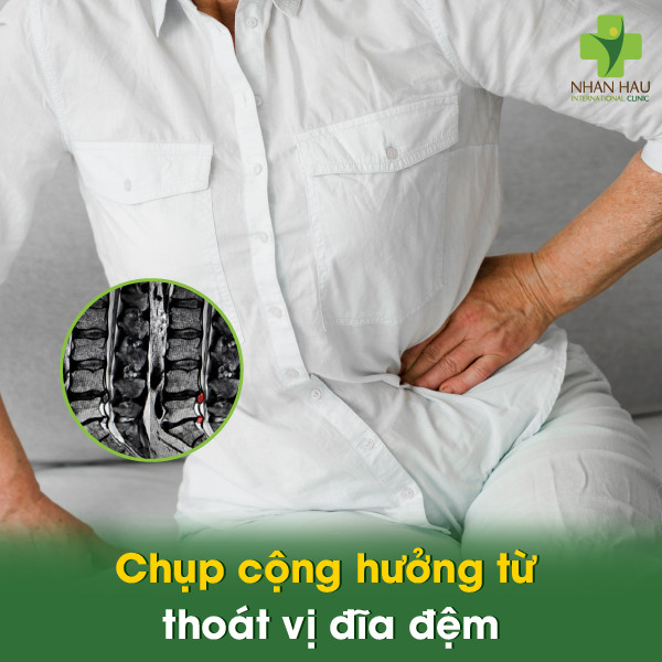 Chụp cộng hưởng từ thoát vị đĩa đệm
