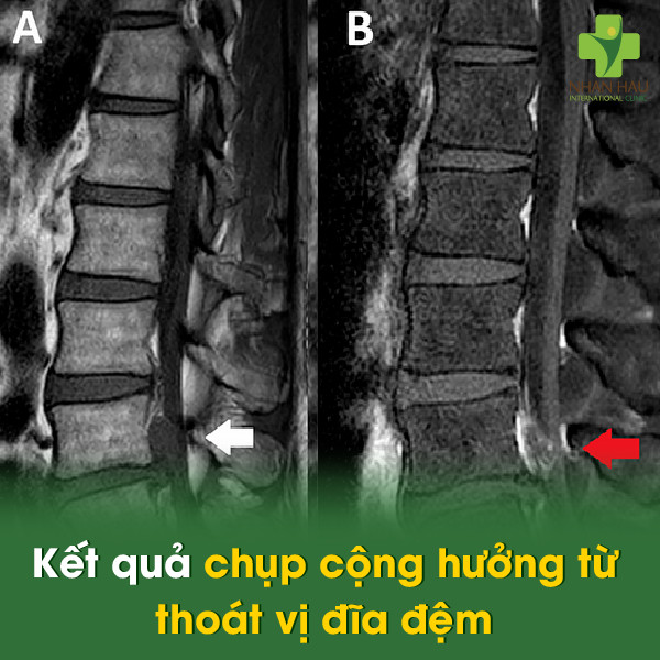 Kết quả chụp cộng hưởng từ thoát vị đĩa đệm