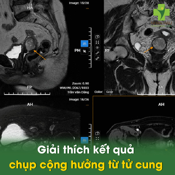Chụp cộng hưởng từ tử cung (MRI tử cung): Đánh giá chi tiết sức khỏe phụ khoa 4 Giải thích kết quả chụp cộng hưởng từ tử cung