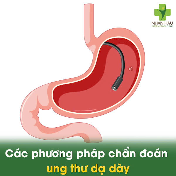 Những Dấu Hiệu Cảnh Báo Ung Thư Dạ Dày Bạn Không Nên Bỏ Qua 5 Các phương pháp chẩn đoán ung thư dạ dày